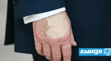 «علامة زرقاء» على يد ترامب تثير جدلاً حول حالته الصحية