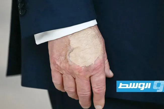 «علامة زرقاء» على يد ترامب تثير جدلاً حول حالته الصحية «علامة زرقاء» على يد ترامب تثير جدلاً حول حالته الصحية