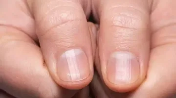 علامة غير مرئية على الأظافر تشير إلى مخاطر صحية كبيرة
