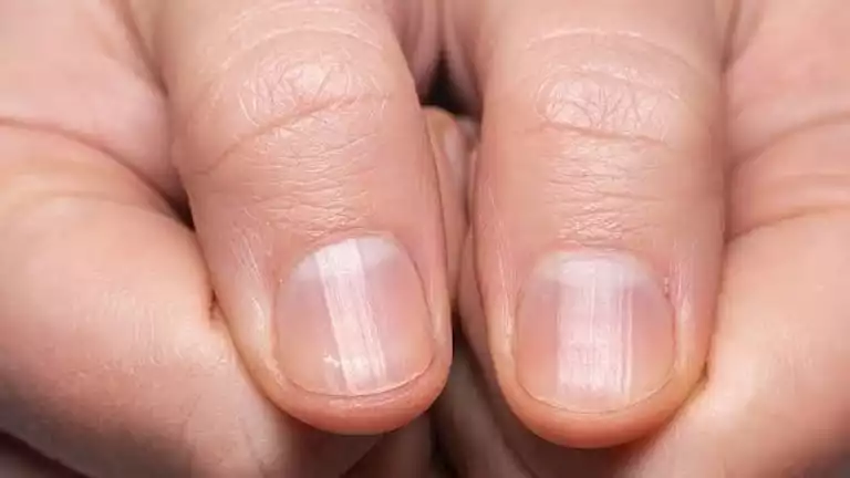 علامة غير مرئية على الأظافر تشير إلى مخاطر صحية كبيرة علامة غير مرئية على الأظافر تشير إلى مخاطر صحية كبيرة