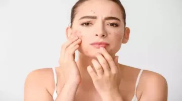 ما هي المخاطر الناتجة عن “فقع البثور” في منطقة مثلث الموت على الوجه؟