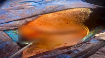 منشار كهربائي يصيب رجل في رقبته وجراحو جامعة أسيوط يتدخلون لإنقاذه – صور