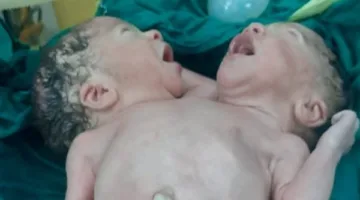 ولادة غير معتادة لتوأم ملتصق في مستشفى الزقازيق الجامعي